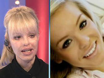 Η συγκλονιστική ιστορία της Katie Piper!