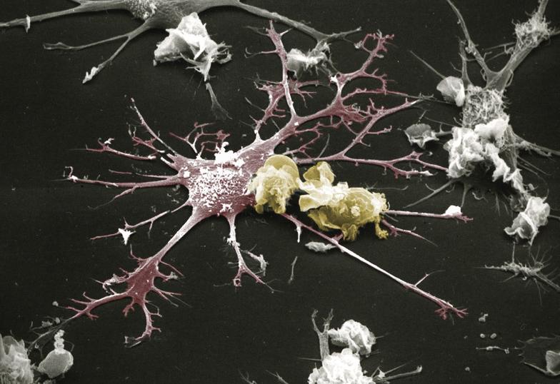 Ακόμα ένα εμβόλιο που αποτυγχάνει να αντιμετωπίσει τον HIV