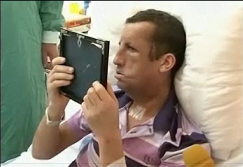 Λήπτης μοσχεύματος στην Τουρκία αντικρίζει το νέο του πρόσωπο