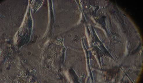 Ανάπλαση κατεστραμμένου κερατοειδή με τη χρήση βλαστοκυττάρων