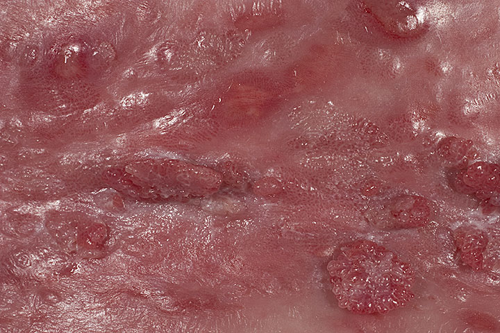 Τα κονδυλώματα προδιαθέτουν στην εκδήλωση καρκίνου