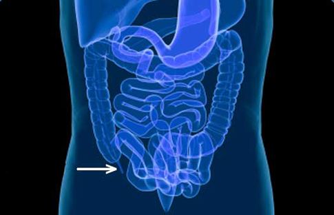 «Άχρηστες» οι περισσότερες επεμβάσεις σκωληκοειδίτιδας
