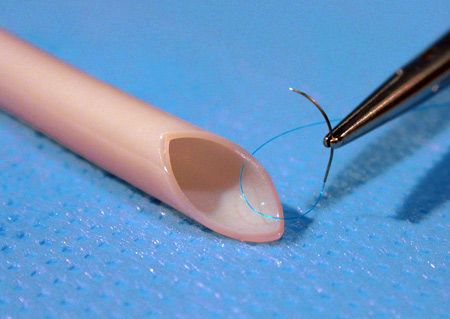 Καλλιεργημένα αγγεία μεταμοσχεύθηκαν με επιτυχία σε ασθενείς