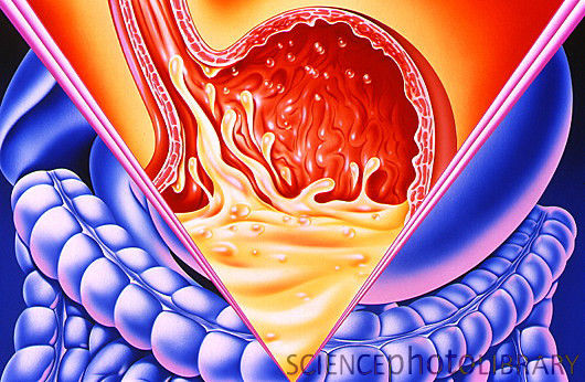Η γαστροοισοφαγική παλινδρόμηση ένα από τα συχνότερα προβλήματα στο φαρμακείο