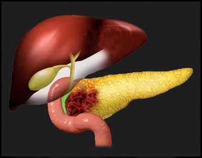 Πειραματικά φάρμακα φιλοδοξούν να μπλοκάρουν τον καρκίνο του παγκρέατος