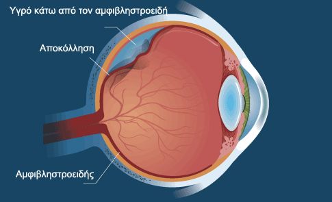 Τι είναι και πώς αντιμετωπίζεται η αποκόλληση αμφιβληστροειδούς