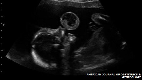 Επιτυχής αφαίρεση όγκου από έμβρυο κατά τη διάρκεια της κύησης