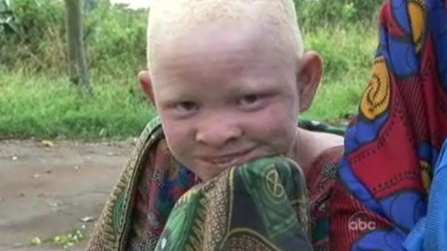 Θύματα δεισιδαιμονιών και αγνοημένοι από τις Αρχές οι αλφικοί της Τανζανίας