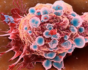 Γονίδιο σταματά διαπαντός τον πολλαπλασιασμό των καρκινικών κυττάρων