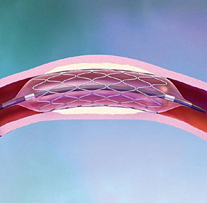 Τα νεότερα (και ακριβότερα) stent δεν είναι κατάλληλα για όλους τους καρδιοπαθείς