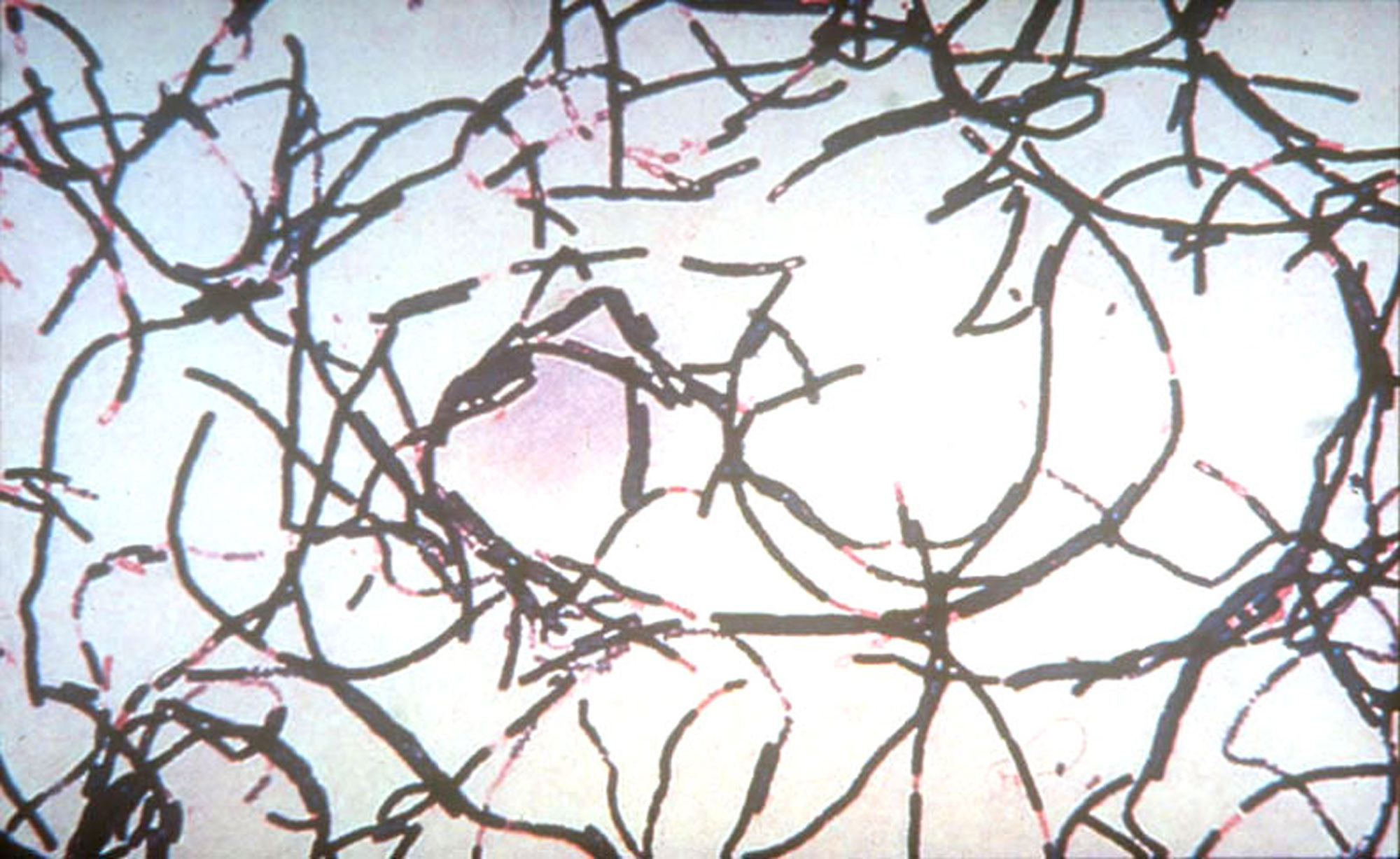 Χρήστης ηρωίνης στη Βρετανία κατέληξε, αφού προσβλήθηκε από την ασθένεια του άνθρακα