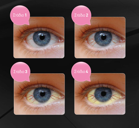Μήπως η οφθαλμογήρανση «απειλεί» την υγεία και ομορφιά των ματιών σας;