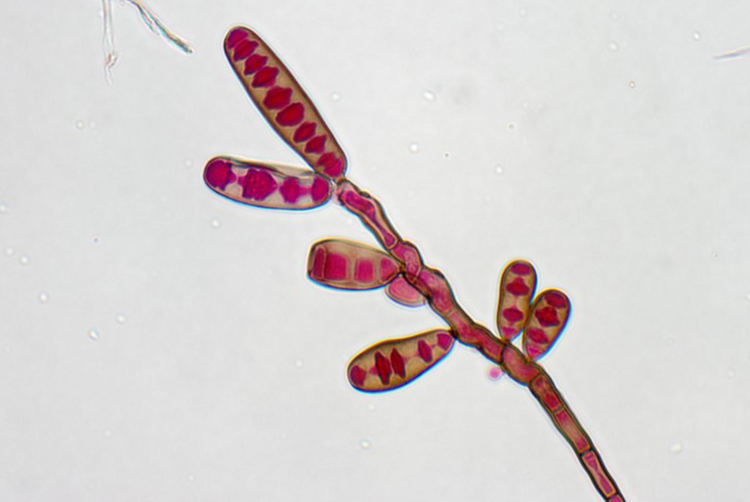 Πρόκληση για τους γιατρούς η αμερικανική επιδημία «μαύρης μούχλας»