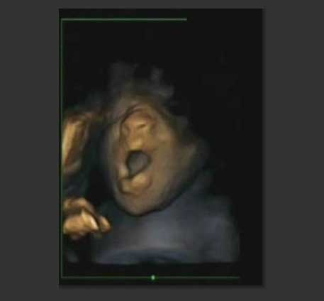 Τελικά τα έμβρυα χασμουριούνται, αποφαίνεται βρετανική μελέτη