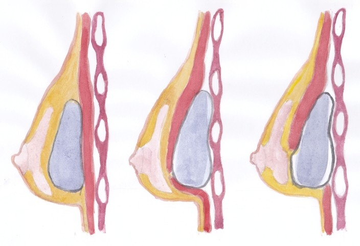 Καλύτερο αισθητικό αποτέλεσμα προσφέρουν τα ανατομικά ενθέματα σιλικόνης μαστού