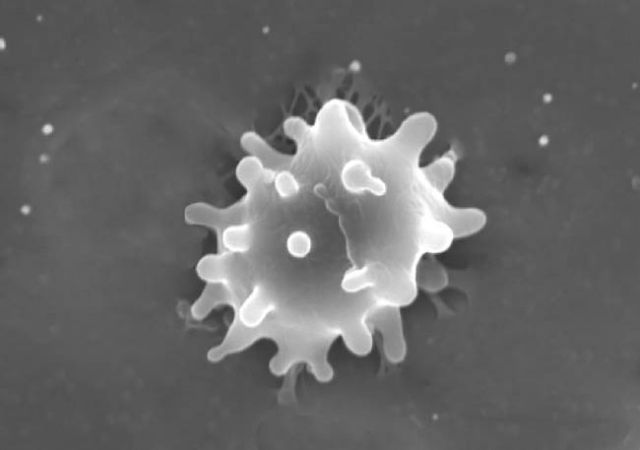 Τροποποιημένα ανοσοκύτταρα δείχνουν να εκριζώνουν τη λευχαιμία