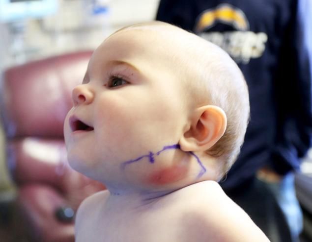 Γιατροί στο Κάνσας αφαίρεσαν… φτερό από το πρόσωπο ενός μωρού