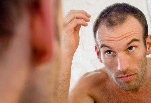 Γιατί οι άνδρες «χάνουν» τα μαλλιά τους;
