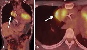 Διεθνής επιστημονική συνάντηση για τα Κακοήθη Λεμφώματα