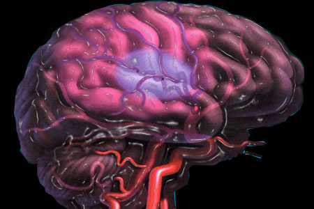 Κύτταρα που επιβιώνουν από το εγκεφαλικό επεισόδιο διαθέτει ο εγκέφαλος