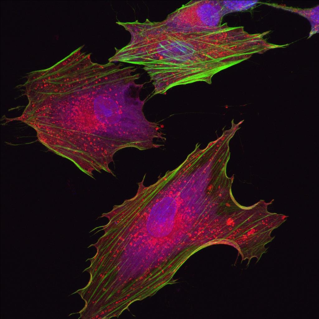 Θεραπεία της νόσου Αλτσχάιμερ με αυτόλογα μεσεγχυματικά κύτταρα για τρεις Έλληνες