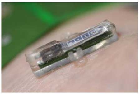 Μίνι μικροβιολογικό εργαστήριο εμφυτεύεται κάτω από το δέρμα