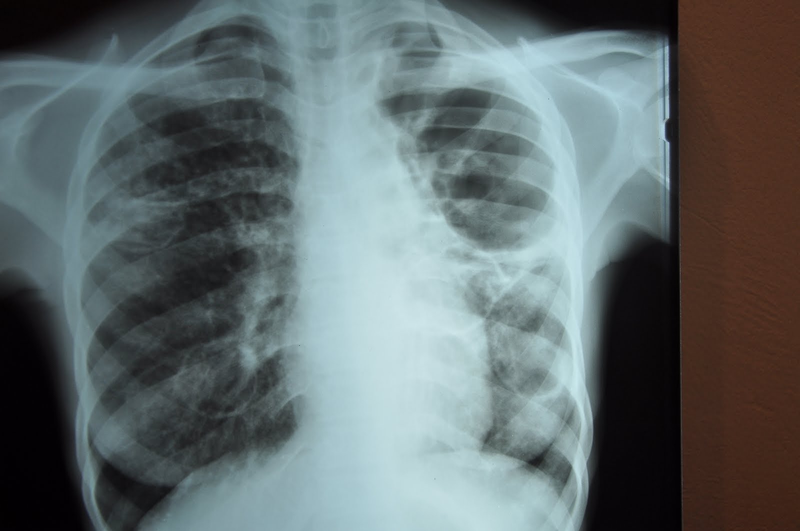Αυξάνονται τα κρούσματα πολυανθεκτικής φυματίωσης στην Ελλάδα