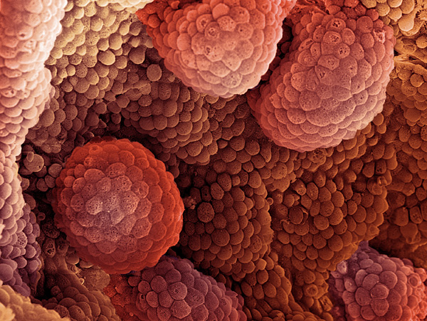 Το γονίδιο BRCA2 καθιστά επιθετικότερο τον καρκίνο του προστάτη