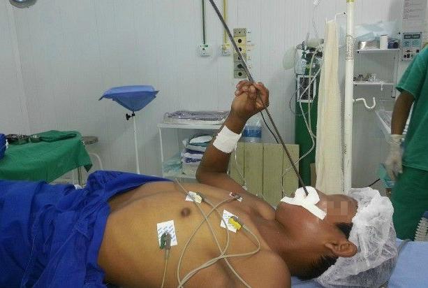 Ταξίδευε δύο μέρες με ένα καμάκι καρφωμένο στο πρόσωπο