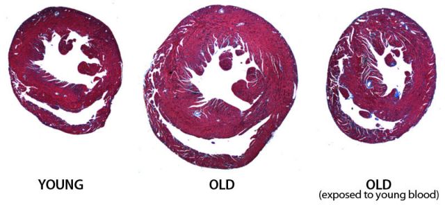 Νεανικό αίμα «κάνει τις γερασμένες καρδιές να ξανανιώσουν»
