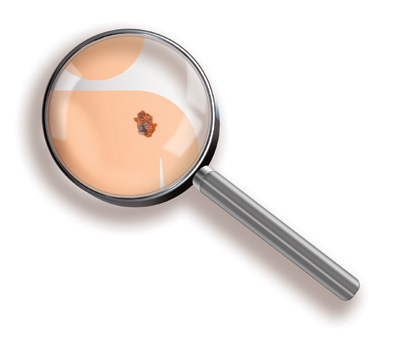 Ελληνική Εβδομάδα κατά του Καρκίνου του Δέρματος: Κάντε δωρεάν εξετάσεις