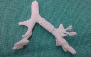 Τρισδιάστατη εκτύπωση μοσχεύματος θεραπεύει σπάνια αναπνευστική πάθηση