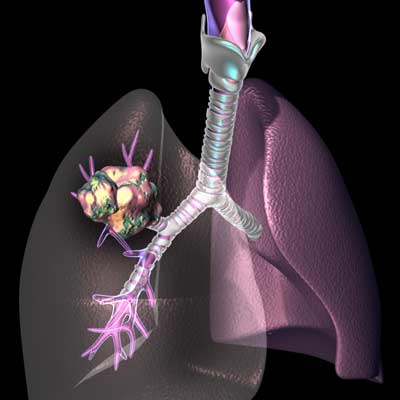 Αποτελεσματικό το μόριο LDK378 στον μη μικροκυτταρικό καρκίνο του πνεύμονα