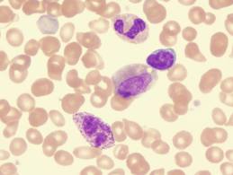 Αποτελεσματικός ο αναστολέας JAK2 στην θεραπεία της μυελοΐνωσης