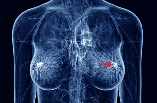 Καρκίνος του Μαστού: Μύθοι και αλήθειες για τα γενετικά τεστ