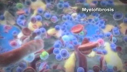 Η ρουξολιτινίμπη βελτιώνει την επιβίωση των ασθενών με μυελοΐνωση