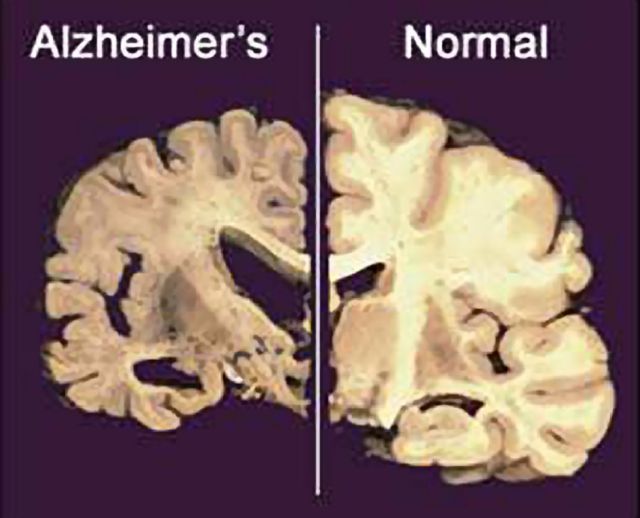 Πιο κοντά οι επιστήμονες σε εξέταση αίματος για το Αλτσχάιμερ