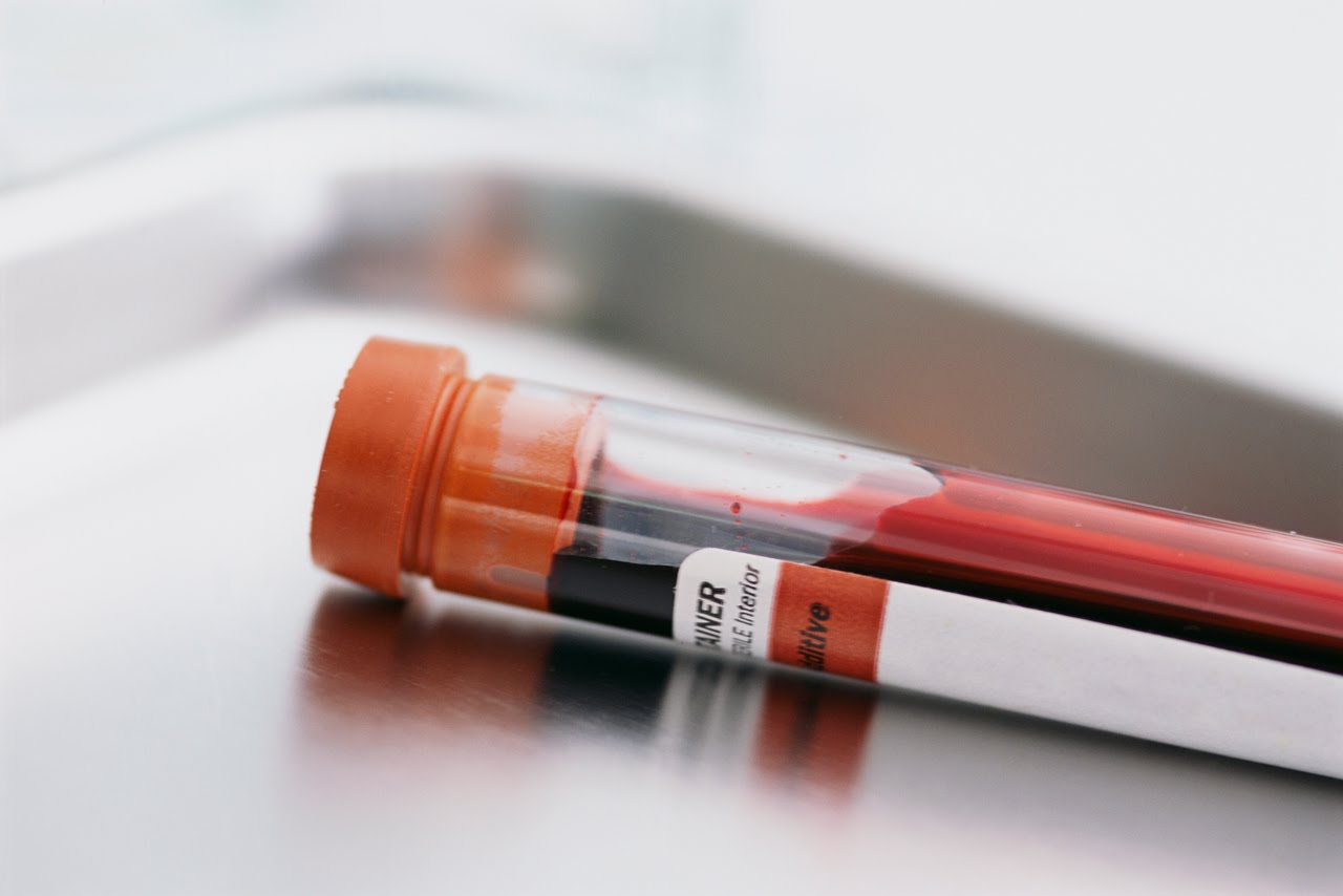 Αιματολογική εξέταση υπόσχεται πρώιμη διάγνωση του καρκίνου των ωοθηκών