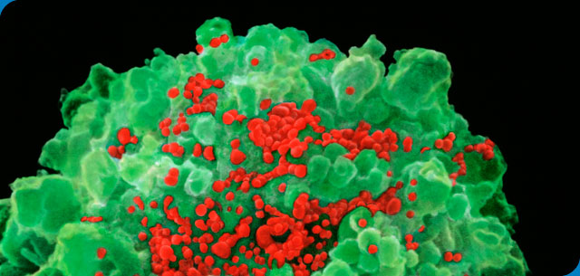 Ανακαλύφθηκε γονίδιο που εμποδίζει την εξάπλωση του AIDS