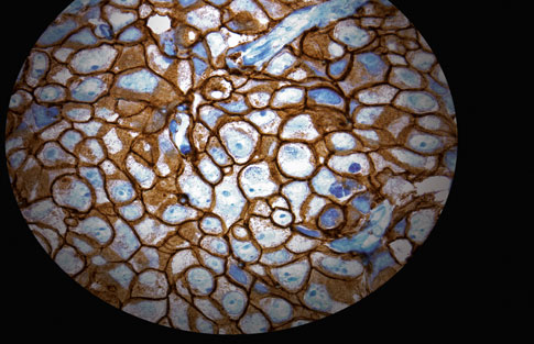 Καρκίνος Μαστού: Τεστ εντοπίζει τις υποψήφιες για θεραπεία με pertuzumab και T-DM1