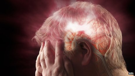 Το άγχος αυξάνει τον κίνδυνο εγκεφαλικού επεισοδίου