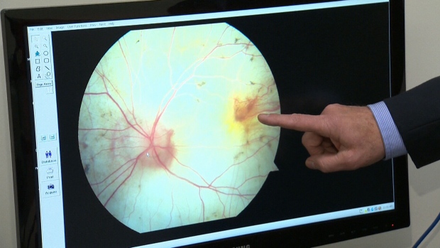 Γονιδιακή θεραπεία προλαμβάνει την απώλεια της όρασης