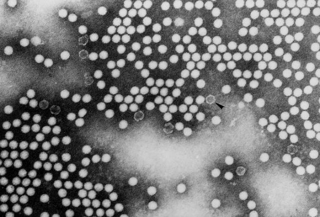 Mυστηριώδης ασθένεια «σαν την πολιομυελίτιδα» εμφανίστηκε στην Καλιφόρνια