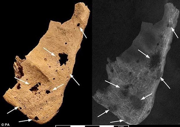 Μεταστατικός καρκίνος βρέθηκε «απολιθωμένος» σε αρχαίο σκελετό