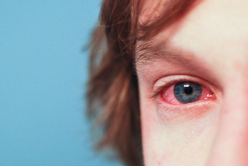 Αλλεργική Επιπεφυκίτιδα: Συμβαίνει μόνο την Άνοιξη;