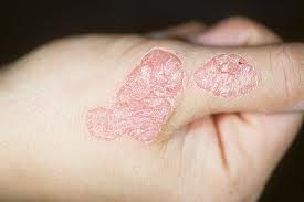 Ενημερωτική εκδήλωση για την ψωρίαση από το σωματείο «Καλυψώ»