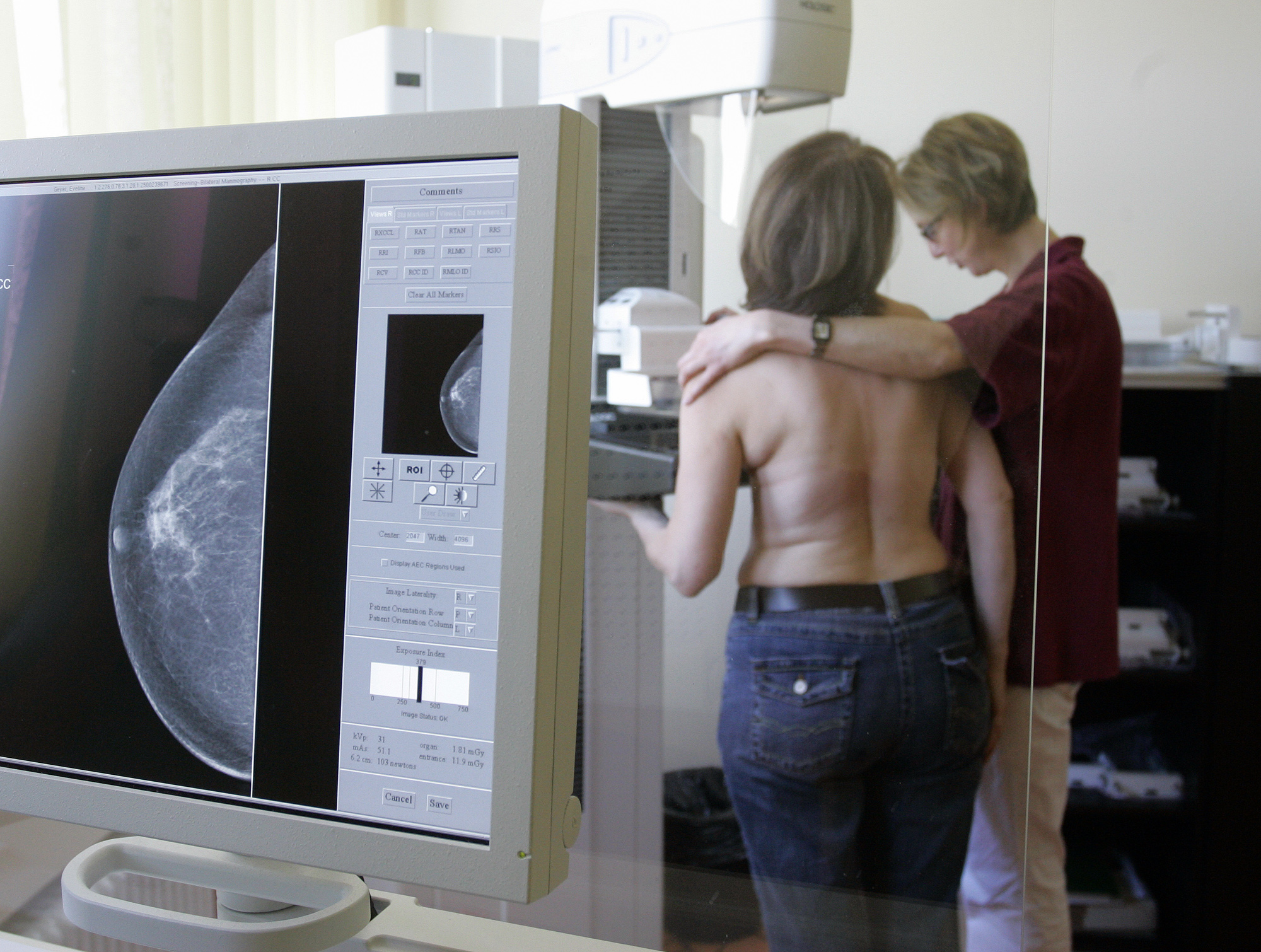 Η μαστογραφία μειώνει τον κίνδυνο θανάτου από καρκίνο του μαστού