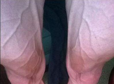 Έτσι είναι τα πόδια ενός ποδηλάτη μετά τον «Γύρο Γαλλίας»