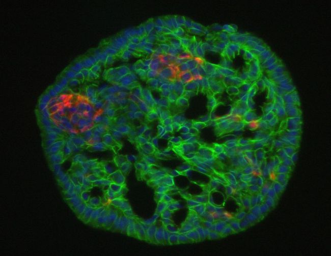 Μαζική παραγωγή β-κυττάρων παγκρέατος υπόσχεται ίαση του διαβήτη τύπου Ι