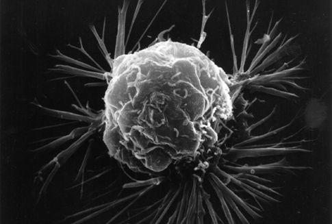 Καρκινικά κύτταρα βρέθηκαν να μολύνουν υγιή με μόρια RNA